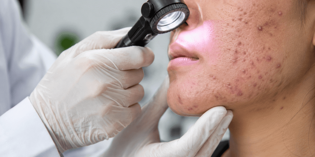 Acne and acne scar treatment at Al Kindi Clinics Center in Al Sadd, Doha